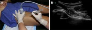 ultrasound-guided-hip-injection