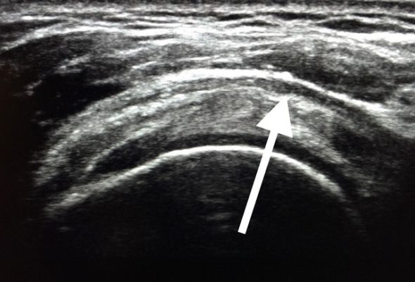 ultrasound-showing-shoulder-bursitis