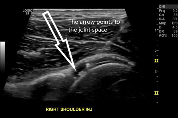 ultrasound-guided-injection-for-shoulder-shoulder