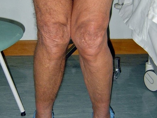 osteoarthritis knee)