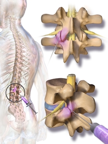 Spinal Injections