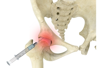 guided-injection-for-oa-hip-pain