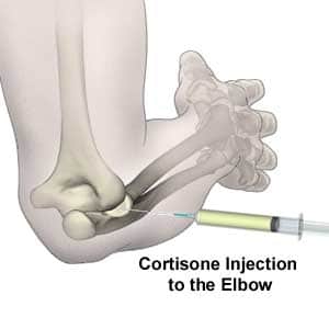 Possible Side Effects of Corticosteroid Injections