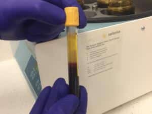 When is Platelet Rich Plasma PRP treatment recommended