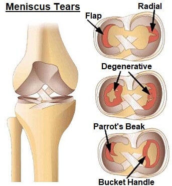 meniscus tears knee injection