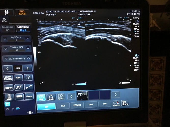rotator-cuff-tear-diagnosis-of-shoulder-problem