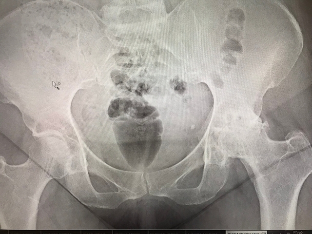 severe-oa-hip-joint